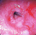 درونبین یا آندوسکوپ (به انگلیسی: endoscope)